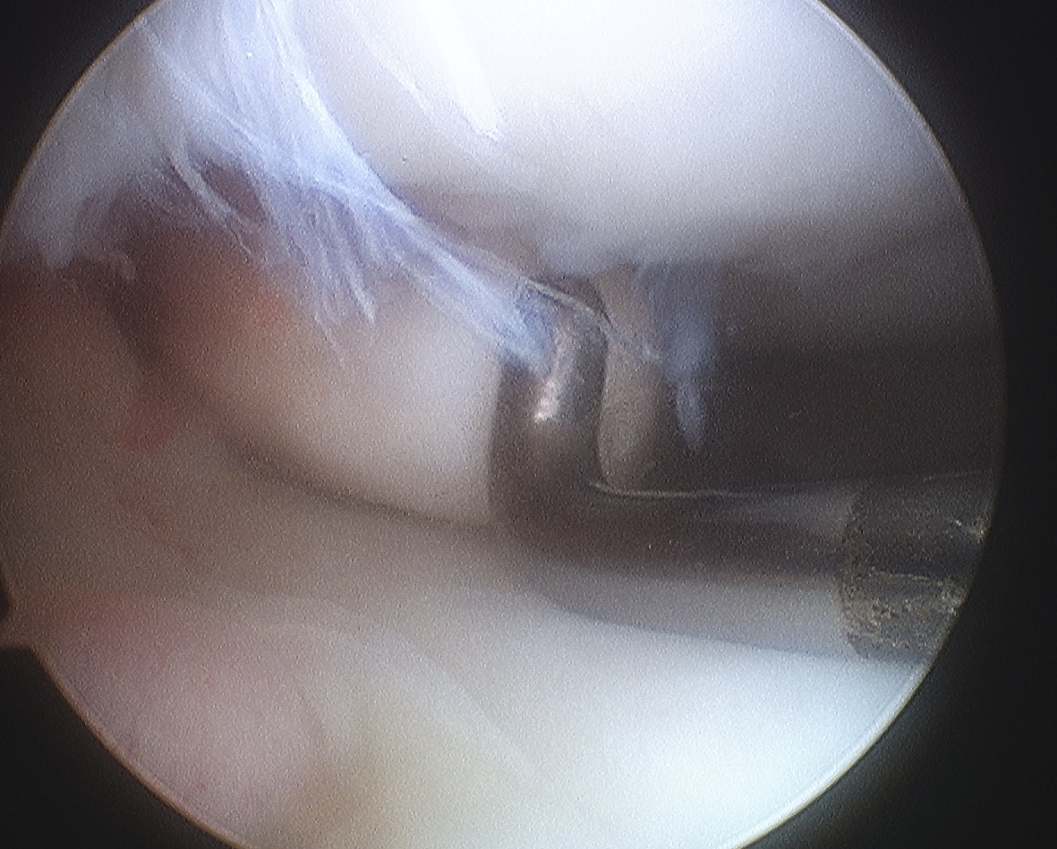 Femoral OCD Type 4 Non salvageable